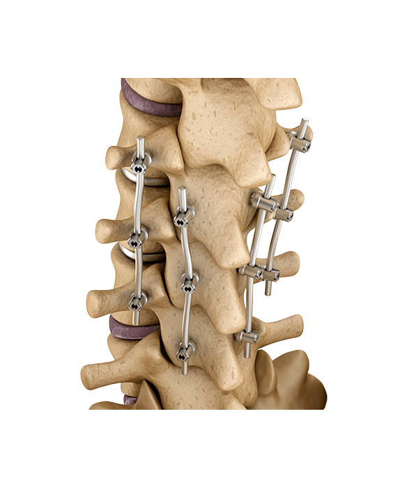 Spine Fixation